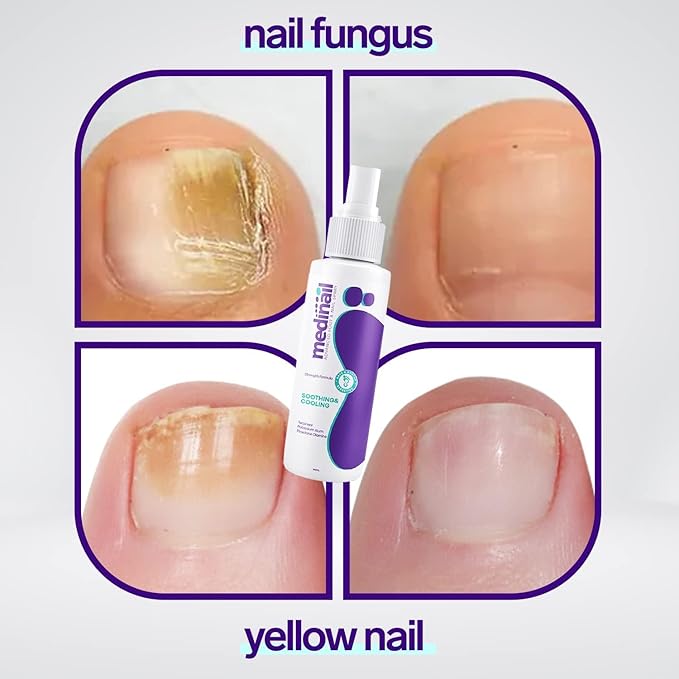 Jaysuin Nail Fungus Spray view 2