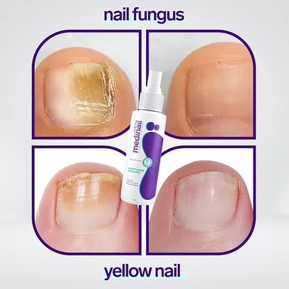 Jaysuin Nail Fungus Spray view 2